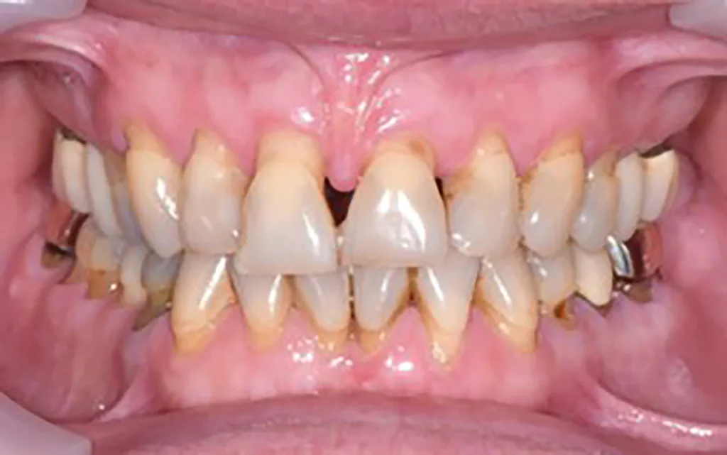 Abb. 4 a–e: Klinische Situation nach Erreichen des parodontalen Therapieziels (pocket closure) und vor Beginn der kieferorthopädischen Therapie. Im Bereich der OK- und UK-Front sind Engstände, Rotationen, Suprapositionen und schwarze Dreiecke mit den durch den Knochenverlust bedingten höhenreduzierten Papillen. PA-Therapie: Daniel Hagenfeld. KFO-Therapie: Jonas Q. Schmid.