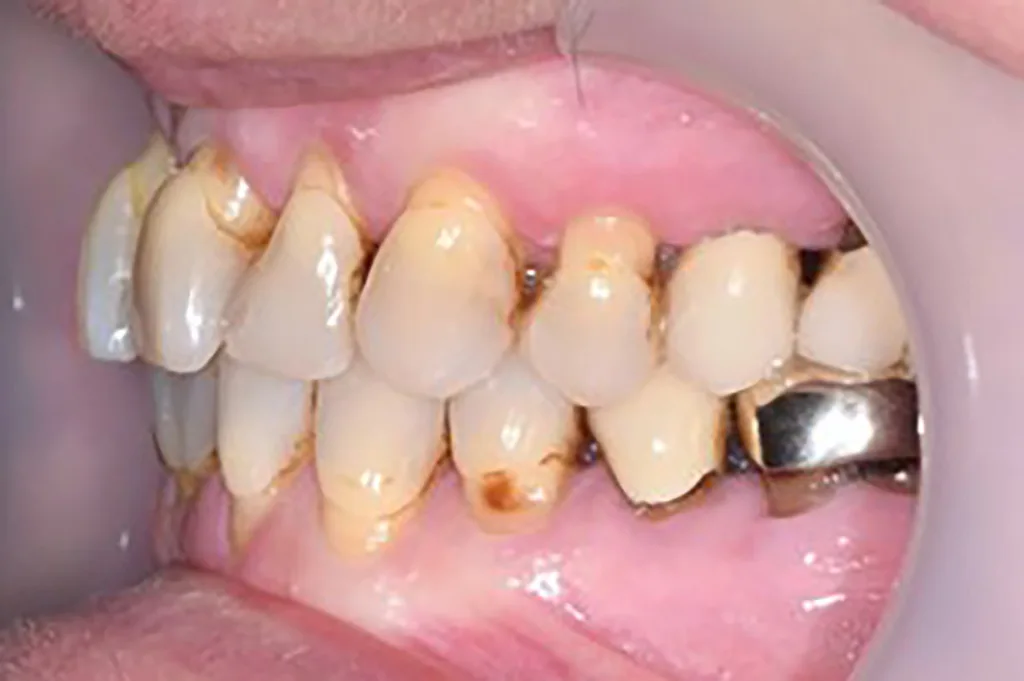 Abb. 4 a–e: Klinische Situation nach Erreichen des parodontalen Therapieziels (pocket closure) und vor Beginn der kieferorthopädischen Therapie. Im Bereich der OK- und UK-Front sind Engstände, Rotationen, Suprapositionen und schwarze Dreiecke mit den durch den Knochenverlust bedingten höhenreduzierten Papillen. PA-Therapie: Daniel Hagenfeld. KFO-Therapie: Jonas Q. Schmid.