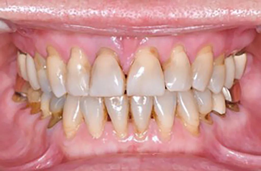 Abb. 6 a–e: Klinische Situation nach kieferorthopädischer Therapie mit Retainern im OK und UK. Die Harmonisierung des Zahnbogens im Bereich der OK- und UK-Front sowie die Optimierung der sagittalen und horizontalen Frontzahnstufe sind deutlich erkennbar.