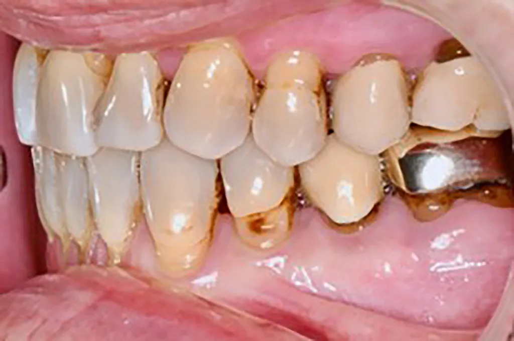 Abb. 6 a–e: Klinische Situation nach kieferorthopädischer Therapie mit Retainern im OK und UK. Die Harmonisierung des Zahnbogens im Bereich der OK- und UK-Front sowie die Optimierung der sagittalen und horizontalen Frontzahnstufe sind deutlich erkennbar.