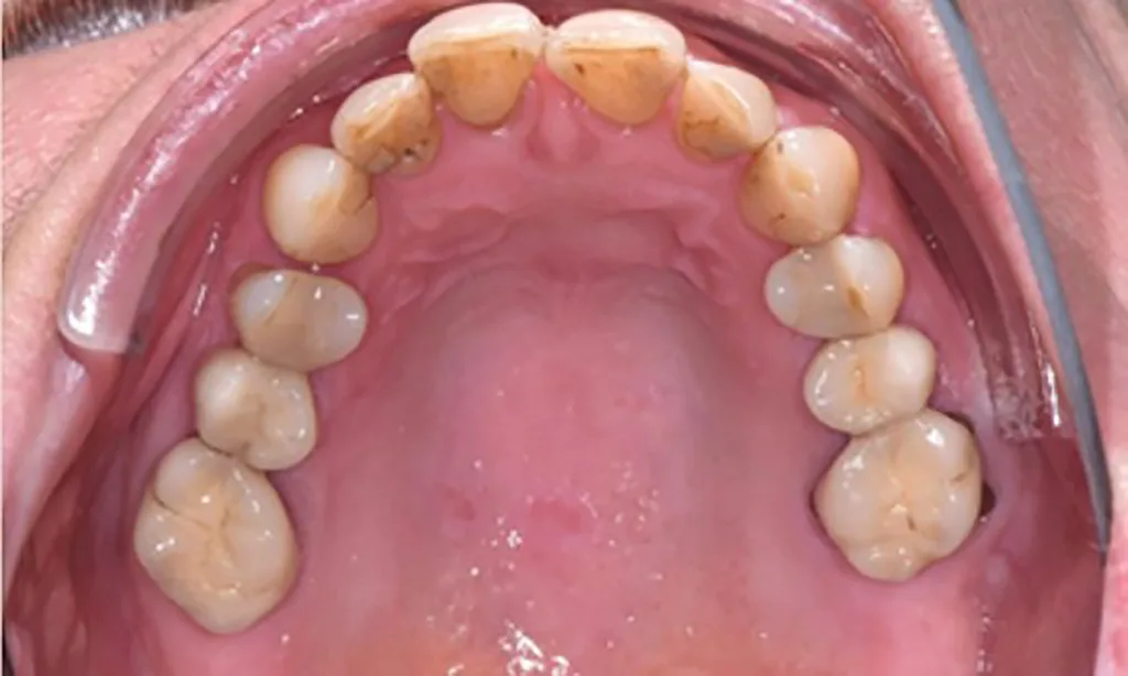 Abb. 4 a–e: Klinische Situation nach Erreichen des parodontalen Therapieziels (pocket closure) und vor Beginn der kieferorthopädischen Therapie. Im Bereich der OK- und UK-Front sind Engstände, Rotationen, Suprapositionen und schwarze Dreiecke mit den durch den Knochenverlust bedingten höhenreduzierten Papillen. PA-Therapie: Daniel Hagenfeld. KFO-Therapie: Jonas Q. Schmid.
