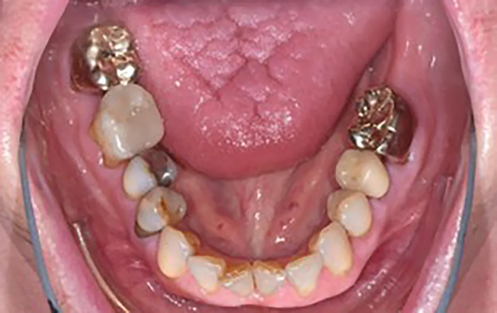Abb. 4 a–e: Klinische Situation nach Erreichen des parodontalen Therapieziels (pocket closure) und vor Beginn der kieferorthopädischen Therapie. Im Bereich der OK- und UK-Front sind Engstände, Rotationen, Suprapositionen und schwarze Dreiecke mit den durch den Knochenverlust bedingten höhenreduzierten Papillen. PA-Therapie: Daniel Hagenfeld. KFO-Therapie: Jonas Q. Schmid.