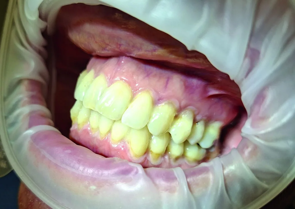 Nach der Applikation des elmex® SENSITIVE PROFESSIONAL Duraphat® Fluoridlack