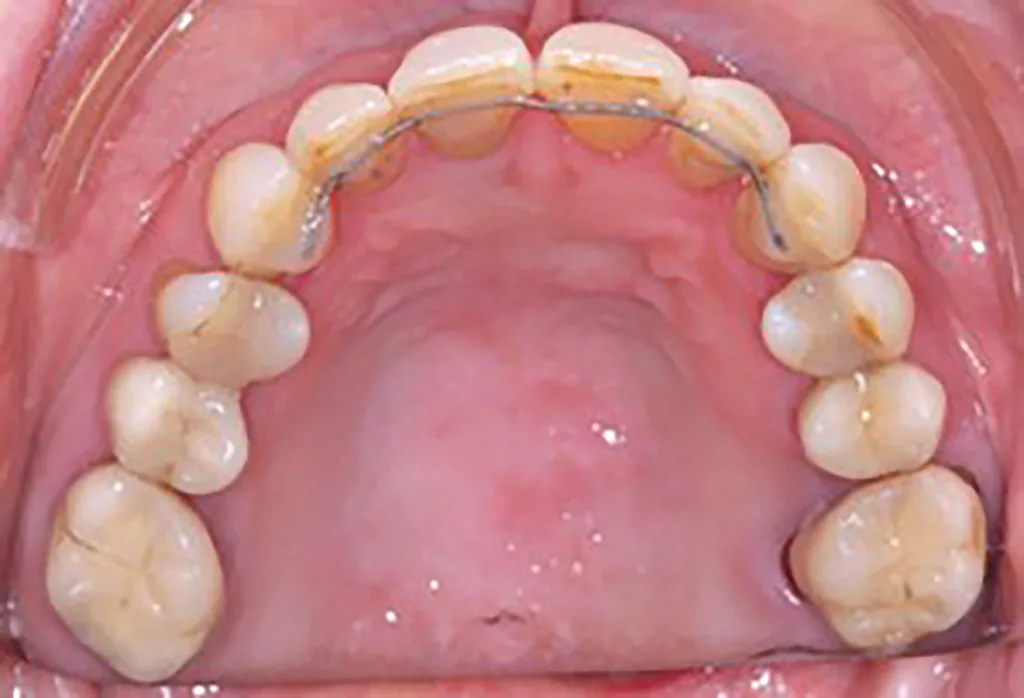 Abb. 6 a–e: Klinische Situation nach kieferorthopädischer Therapie mit Retainern im OK und UK. Die Harmonisierung des Zahnbogens im Bereich der OK- und UK-Front sowie die Optimierung der sagittalen und horizontalen Frontzahnstufe sind deutlich erkennbar.