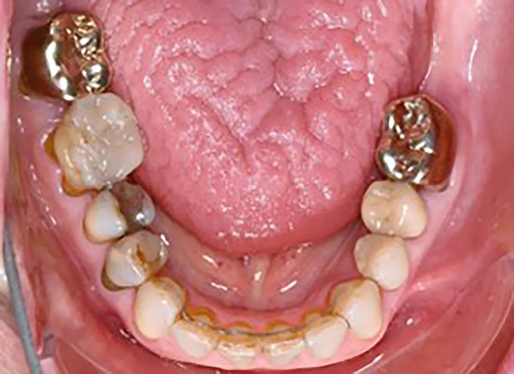 Abb. 6 a–e: Klinische Situation nach kieferorthopädischer Therapie mit Retainern im OK und UK. Die Harmonisierung des Zahnbogens im Bereich der OK- und UK-Front sowie die Optimierung der sagittalen und horizontalen Frontzahnstufe sind deutlich erkennbar.