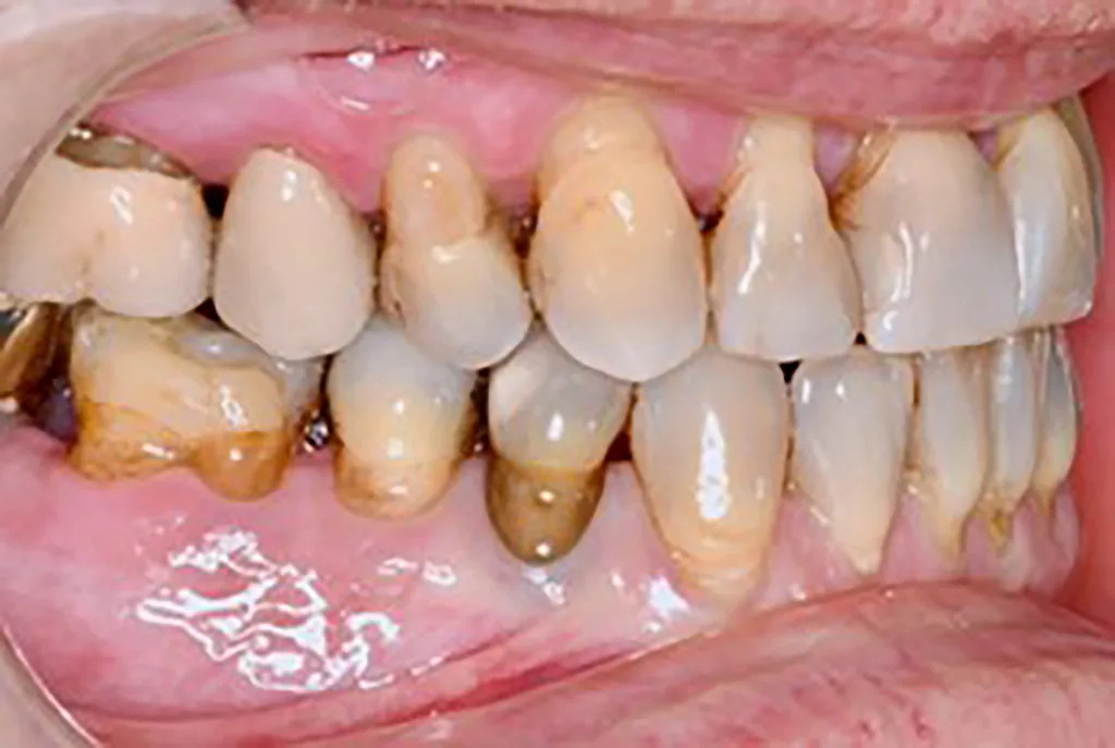 Abb. 6 a–e: Klinische Situation nach kieferorthopädischer Therapie mit Retainern im OK und UK. Die Harmonisierung des Zahnbogens im Bereich der OK- und UK-Front sowie die Optimierung der sagittalen und horizontalen Frontzahnstufe sind deutlich erkennbar.
