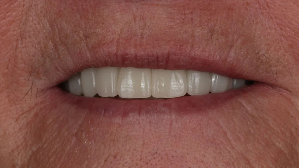Abb.10: Try-in im Patientenmund.