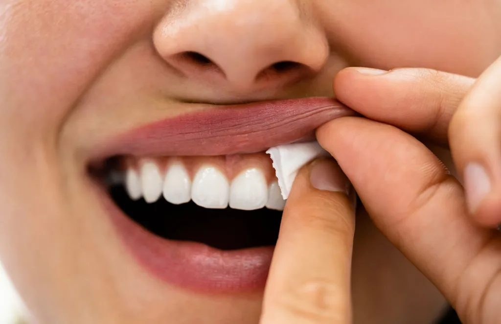 Da Snus und Nikotin-Pouches über die Mundschleimhaut eingenommen werden, kommt es bei Konsumenten besonders häufig zu oralen Läsionen, Schleimhautverdickungen und Gingivarezessionen.