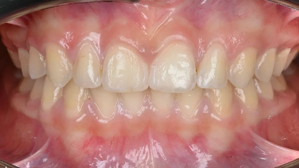 Abb. 4: Behandlungsprotokoll einer MIH: Das klinische Beispiel zeigt den stufenweisen Verlauf bei einer MIH-Opazität im Frontzahnbereich: Nach der initialen Befundaufnahme und einem vierwöchigen Bleaching-Protokoll mit täglich einstündiger Anwendung wird das ästhetische Ergebnis reevaluiert. Anschließend werden die verbliebenen-weißlichen Opazitäten durch Infiltration weiter maskiert.