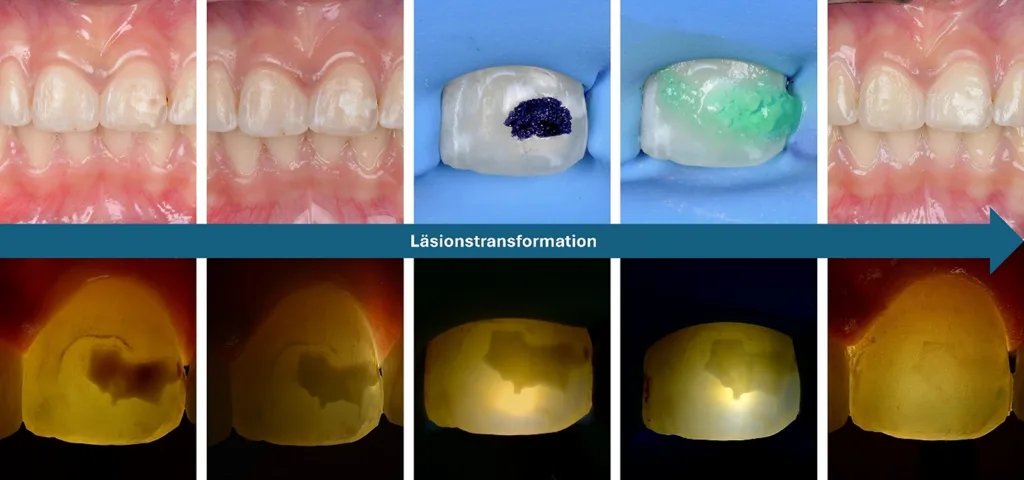 Abb. 5: Transilluminationsbefund MIH-Läsionen: Transilluminationsbefunde einer MIH-Läsion über den gesamten Behandlungsverlauf. (1) Ausgangsbefund (2) nach der Vorbehandlung mit Carbamidperoxidgel 5% (3) nach selektiver Oberflächenentfernung durch Mikroabrasion (4) nach der Oberflächenkonditionierung mit HCl Gel (5) nach abgeschlossener Infiltration. Die Durchleuchtung unterstützt die Beurteilung der Läsionsränder, der Ausdehnung und der lichtdynamischen Eigenschaften der Opazität.