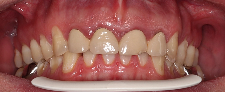 Abb. 2a: Die Zähne 12 bis 22 sind endodontisch vorbehandelt und mit einem Kronenblock versorgt. Die Krone 21 ist inzisal frakturiert.