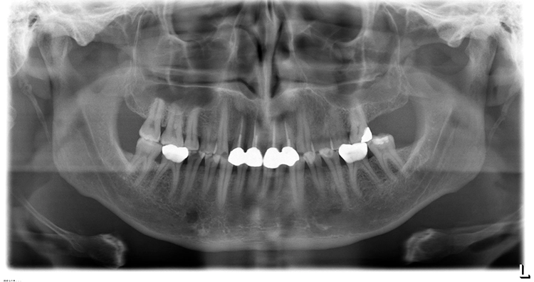 Abb. 2b: Die Zähne 12 bis 22 sind endodontisch vorbehandelt und mit einem Kronenblock versorgt. Die Krone 21 ist inzisal frakturiert.