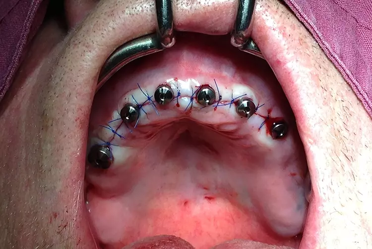 Abb. 3: Naht gelegt: Gingivaformer eingebracht, Lappenränder mittels Einzelknopfnähten
fixiert.