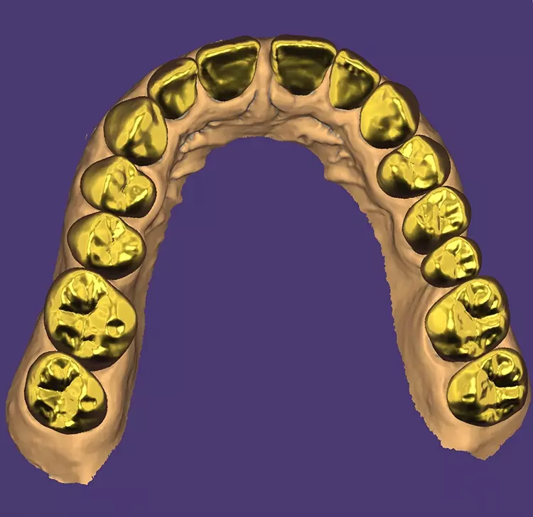 Abb. 3a-d: Nach dem Erfassen der präparierten Situation mit dem Intraoralscanner erfolgte die Herstellung der virtuellen CAD-Modelle und die Konstruktion der Kronen und Brücken in der Software (exocad).