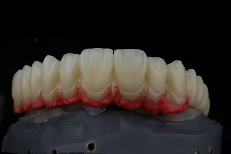 Abb. 3: Verblendkeramik-Schichtung der Gingivaanteile.
