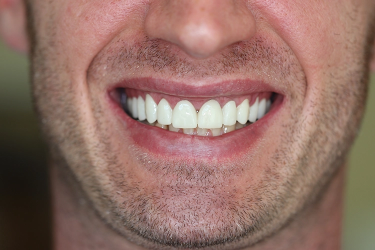 Abb. 4a: Ergebnis nach drei Monaten mit girlandenförmigem Gingivaverlauf und optimierten Proportionen zwischen Kronen und Gingiva.