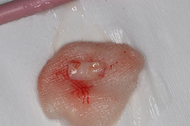 Abb. 10: Aus dem Gaumen entnommenes Schleimhauttransplantat.