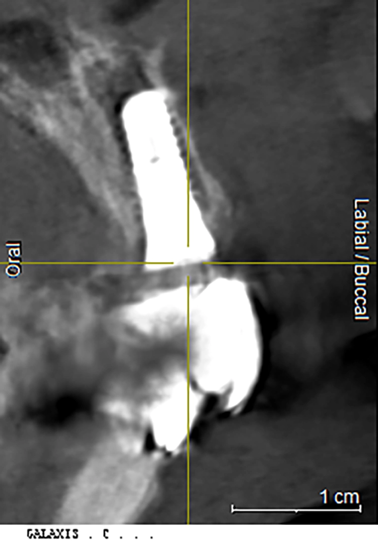 Abb. 13: Röntgenkontrolle nach Insertion des Implantats regio 11.