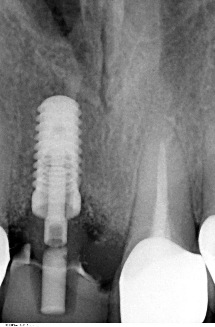 Abb. 14b: Situation nach Einheilzeit (provisorisches Abutment aus PEEK und Komposit-Brücke).