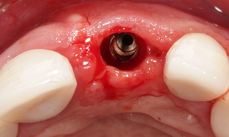 Abb. 15: Nach der Ausformung des Emergenzprofils mit 4 mm-hohem Gingivaformer.
