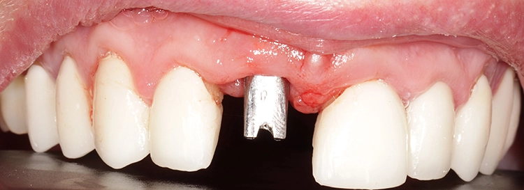 Abb. 16: Situation mit verschraubtem Abutment.