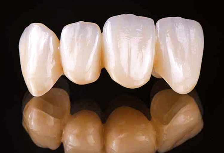 Abb. 1: Verblendfreie Brücke aus Multilayer-Zirkonoxiden (3Y/4Y/5Y-TZP) mit
fließendem Schichtverlauf (IPS e.max ZirCAD Prime, Auflichtbild.)