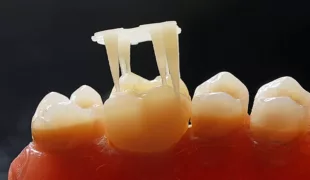 Die definitive, 3D-gedruckte Restauration aus dem Cerec/inLab Workflow ist keine Zukunftsvision, sondern bereits Realität.