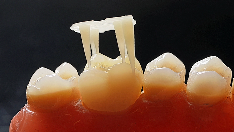 Die definitive, 3D-gedruckte Restauration aus dem Cerec/inLab Workflow ist keine Zukunftsvision, sondern bereits Realität.