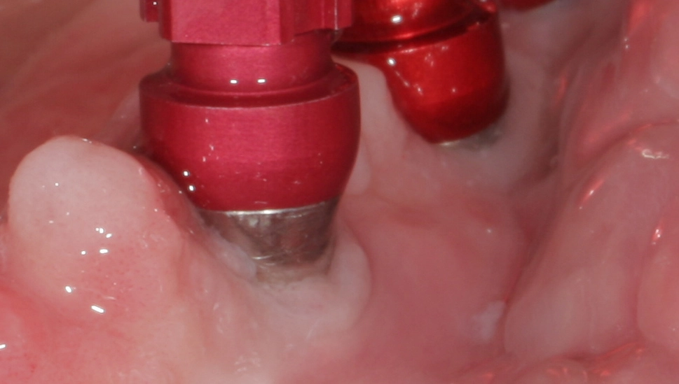 Abb. 24: Weit supragingival liegendes Implantatniveau 34.