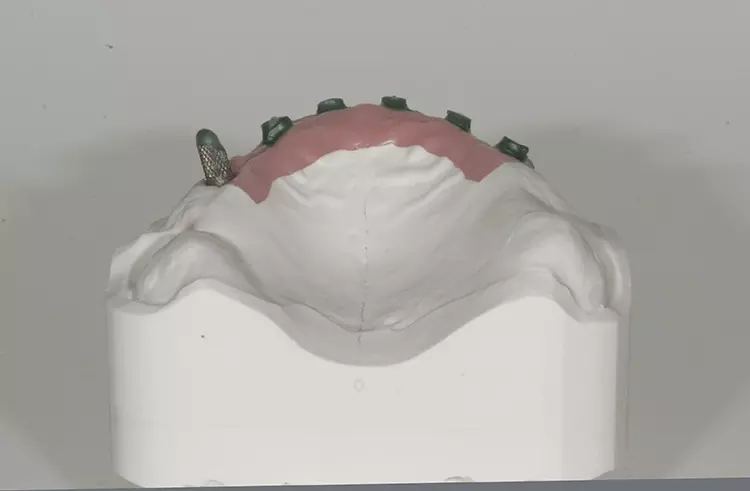 Abb. 28: Austrittsöffnungen der Implantate und provisorisches Abutment.