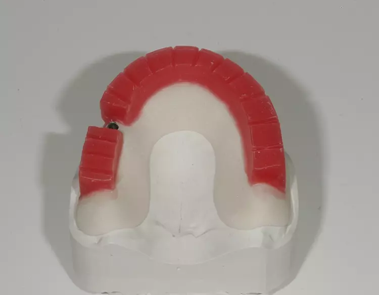 Abb. 29: Verschraubte Bissschablone mit Bisswall.