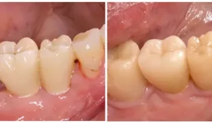 Die erste Langzeitstudie zu zweiteiligen Zirkonoxidimplantaten zeigte klinische Verbesserungen der Weichgewebe (rechts) im Vergleich zur Ausgangslage (links) – mit einem
Zuwachs an keratinisierter Gingiva.
