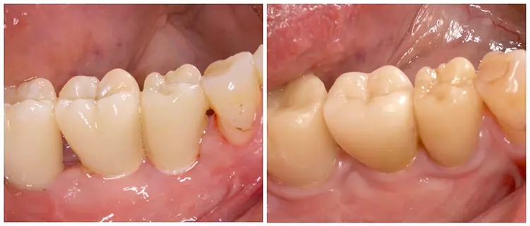 Die erste Langzeitstudie zu zweiteiligen Zirkonoxidimplantaten zeigte klinische Verbesserungen der Weichgewebe (rechts) im Vergleich zur Ausgangslage (links) – mit einem
Zuwachs an keratinisierter Gingiva.