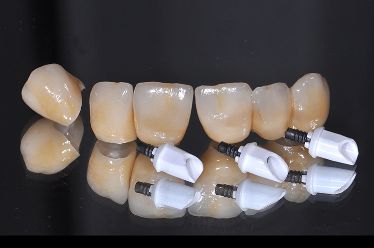 Abb. 1: Zirkonoxid-Abutments (3Y-TZP) mit Verschraubung und Kronen aus transpa-rentem Polychrom-Zirkonoxid (4Y/5Y-TZP) mit farblicher Charakterisierung.