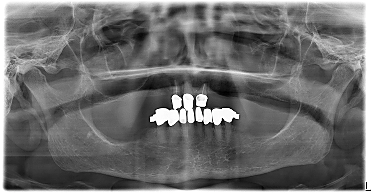 Abb. 2: Röntgenbefund der Ausgangssituation. Zähne 12, 11, 21 mit deutlich verbreitertem Parodontalspalt, horizontal generalisierter Knochenabbau im UK, reduziertes Knochenangebot im Bereich des Sinus maxillaris. Eine implantologische Analyse ist hier nur nach Anfertigung eines DVT möglich, das zur Planung mit einer prothetischen Struktur überlagert (Matching) werden kann.