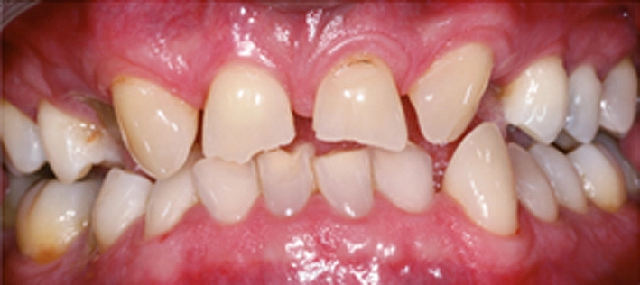 Die Cerec-Applikation OraCheck und das Dynamische Digitale Modell sind Werkzeuge für die Patientenanalyse. Sie machen Veränderungen sichtbar und geben Hinweise auf Abrasion, Erosion, Materialabplatzung, Schwellung, Rezession, Plaque und veränderte Zahnpositionen. Bildsequenz: Ausgangsbefund.