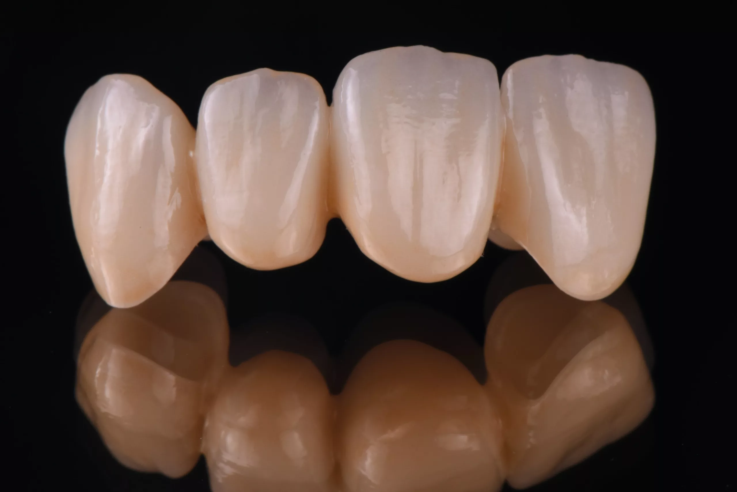 FZ-Brücke aus mehrschichtigem Zirkonoxid mit fließendem Schichtverlauf (e.max ZirCAD Prime).