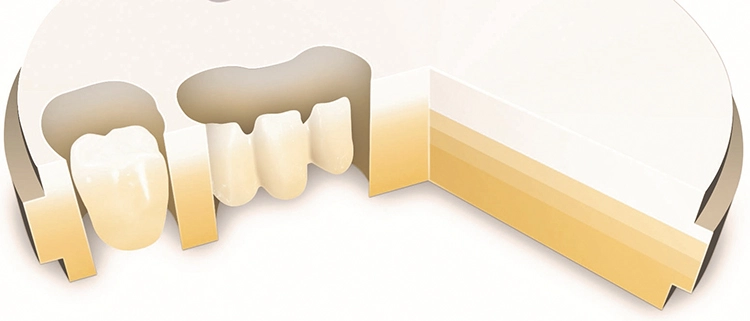 Abb. 2: Mehrschichtiges Zirkonoxid für verblendfreie Kronen und Brücken verfügt über Opazität, Farbverlauf und Transluzenz von Dentin und Schmelz.