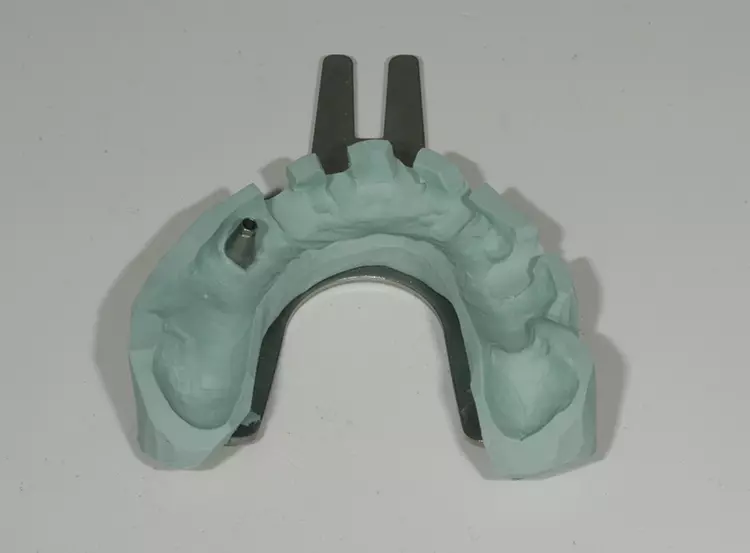 Abb. 31: Bissgabel mit Verschraubungsmöglichkeit.