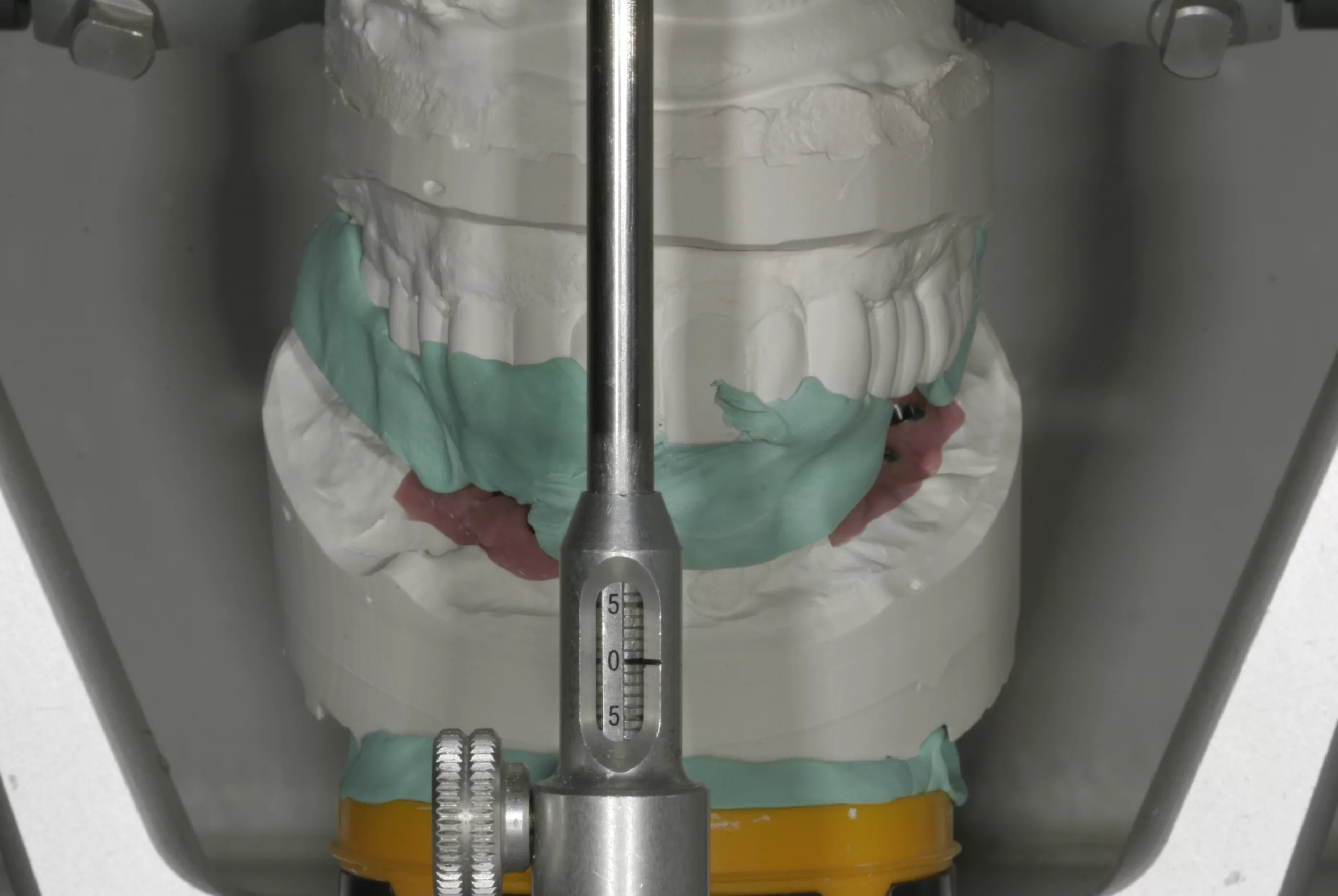 Abb. 31: Gegenbiss mit provisorischem Biss eingestellt.