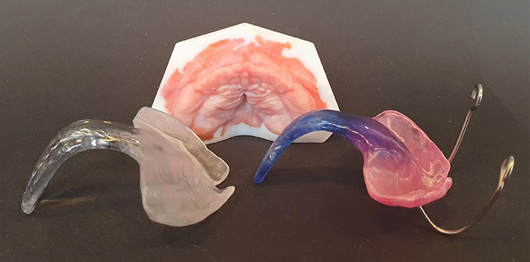 Abb. 3: Tübinger Spornplatten mit Additiv gefertigtem Farbmodell aus einem Intraoralscan. Links die Platte aus dem digitalen Workflow; recht eine Platte aus konventioneller Fertigung.