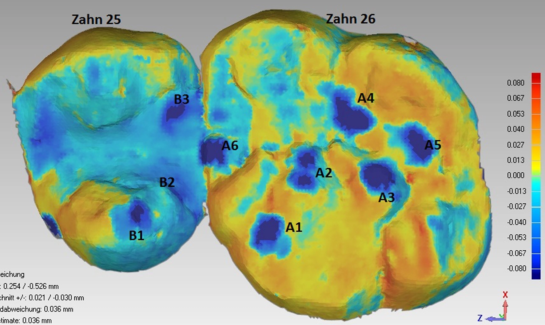 Überlagerung von 2 intraoralen, digitalen Abformungen, die zu unterschiedlichen Zeitpunkten erfasst worden sind. Die morphologischen Unterschiede auf den Kauflächen sind farbcodiert. Die dunkelblauen Areale zeigen die Bereiche mit einem erhöhten, vertikalen Substanzverlust.