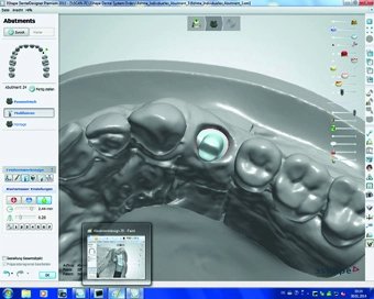Abb. 3: Gestaltung des Abutments im Computer.