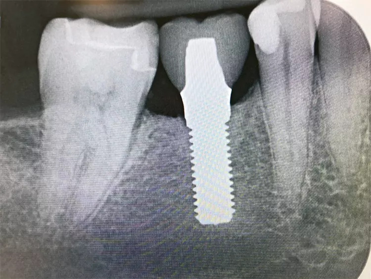 Abb. 3: Langzeitstabiler Knochen: Ein Patent™ Implantat nach 14 Jahren Tragezeit.