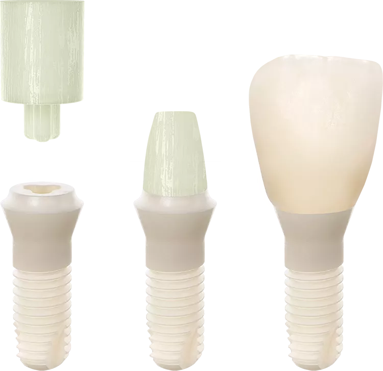 Abb. 4: Beispiellose Langzeitstabilität: In das äquigingival
platzierte Patent™ Implantat wird ein Glasfaserstift
zementiert, der mittels Diamantbohrer präpariert
und wie ein natürlicher Zahn prothetisch versorgt
wird. Dieses stufenlos individualisierbare Abutment
dient mit seinen dentinähnlichen Eigenschaften als
fl exibles Dämpfungselement im Rahmen der Gesamtversorgung.