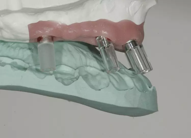 Abb. 41: Problem: extrem nach labial aufgefächerte Implantatstellung.