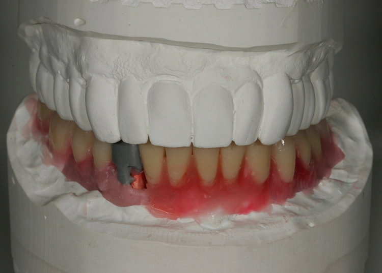 Abb. 47: Wax-up und Aufstellung im Schlussbiss.