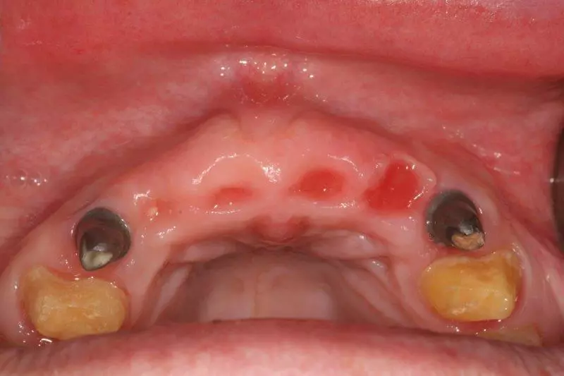 Kontrolle 10 Monate post OP.