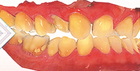 Die Cerec-Applikation OraCheck und das Dynamische Digitale Modell sind Werkzeuge für die Patientenanalyse. Sie machen Veränderungen sichtbar und geben Hinweise auf Abrasion, Erosion, Materialabplatzung, Schwellung, Rezession, Plaque und veränderte Zahnpositionen. Bildsequenz: Präprothetische digitale Funktionsanalyse.