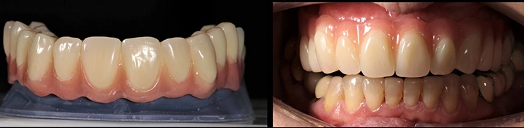 Vollprothese aus dem 3D-Drucker.